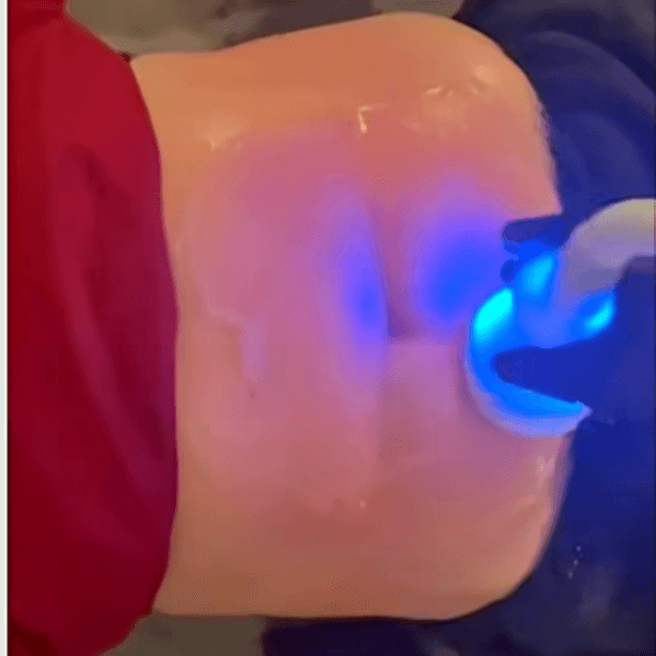 CryoSlimming 5 sessions at CryoLAB Staten Island in Staten Island, NY